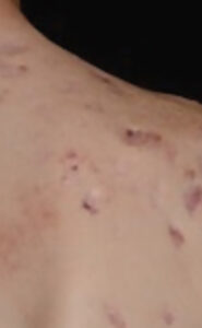 Atrophic scars on the back and shoulder