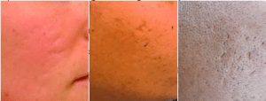 Atrophic changes in association with hyperpigmentation acne scars