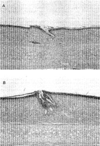 Squalene peroxide comedogenesis
