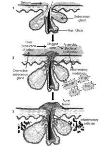 Acne in development, inflammatory factors to address in treatment