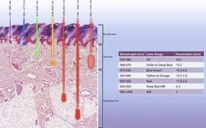 Laser resurfacing for treatment of acne scars- depth of various types into the skin