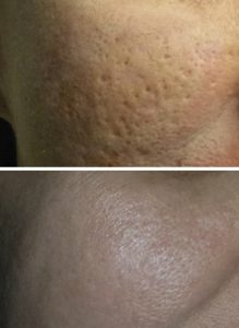 Acne scars treated with dermabrasion and chemcial peels