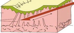 Subcision surgery technique for acne scars