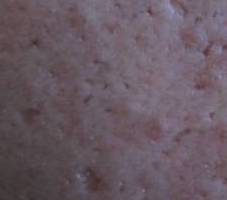 Acne scars, a combination of icepick and boxcar scarring