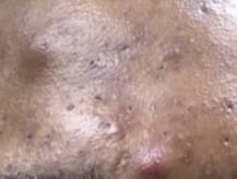 Image of a cystic acne