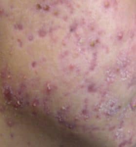 Acne lesions associated with pseudo scars
