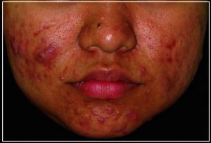 Nodulo cystic acne treatment