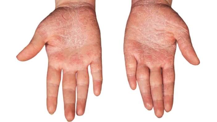 topical treatments for psoriatic skin disease
