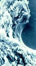 Electron microscopy of a comedo, which is more amenable to acne treatment