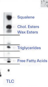 Skin surface lipids and how they change to cause oily skin