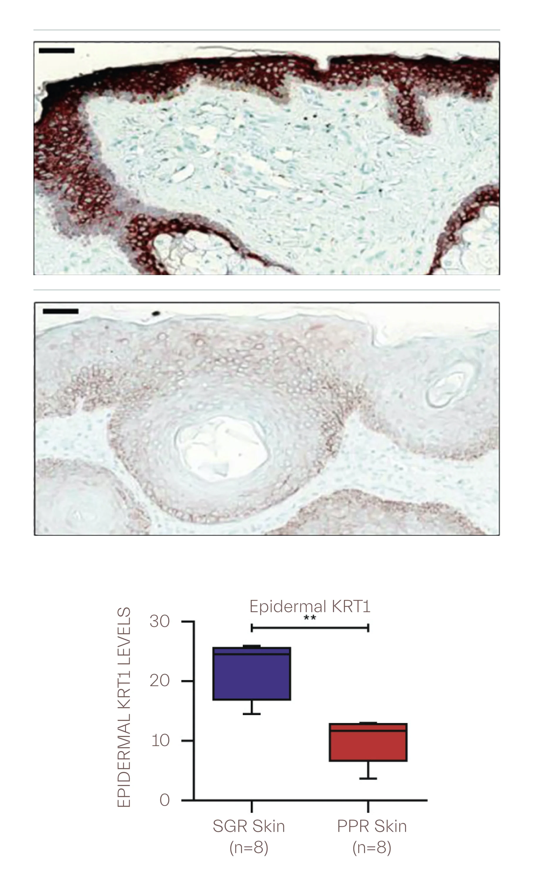 Loss of epidermal proteins, KRT1, in rosacea, top slide)healthy skin, bottom slide) skin with rosacea.